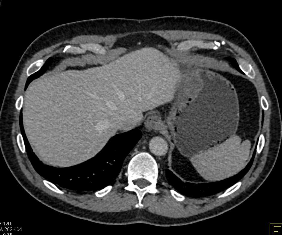 Gastric Adenocarcinoma - CTisus CT Scan