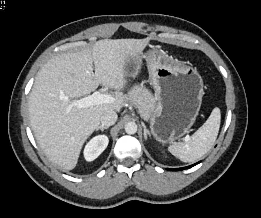Gastric Adenocarcinoma - CTisus CT Scan
