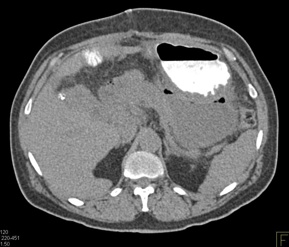 Lesser Sac Abscess Simulates an Unopacified Stomach - CTisus CT Scan