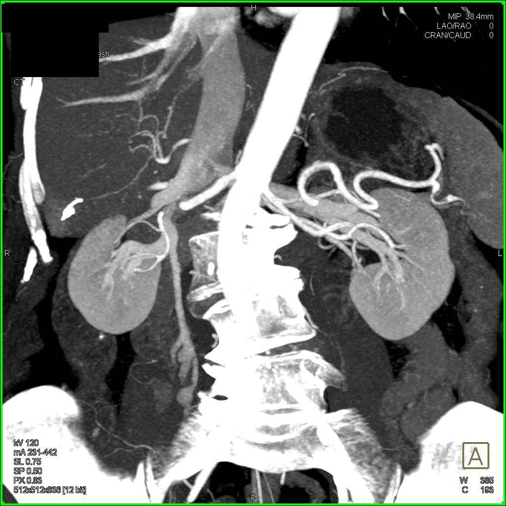 Active Bleed in the Gastric Antrum - CTisus CT Scan