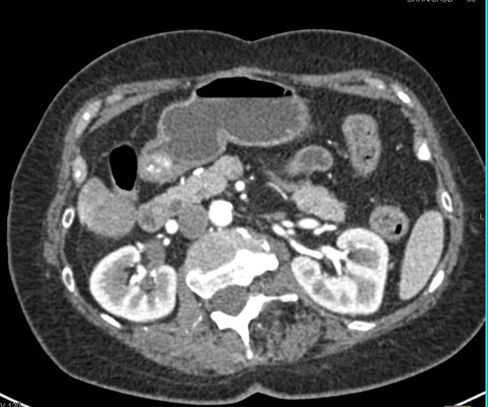 Active Bleed in the Gastric Antrum - CTisus CT Scan
