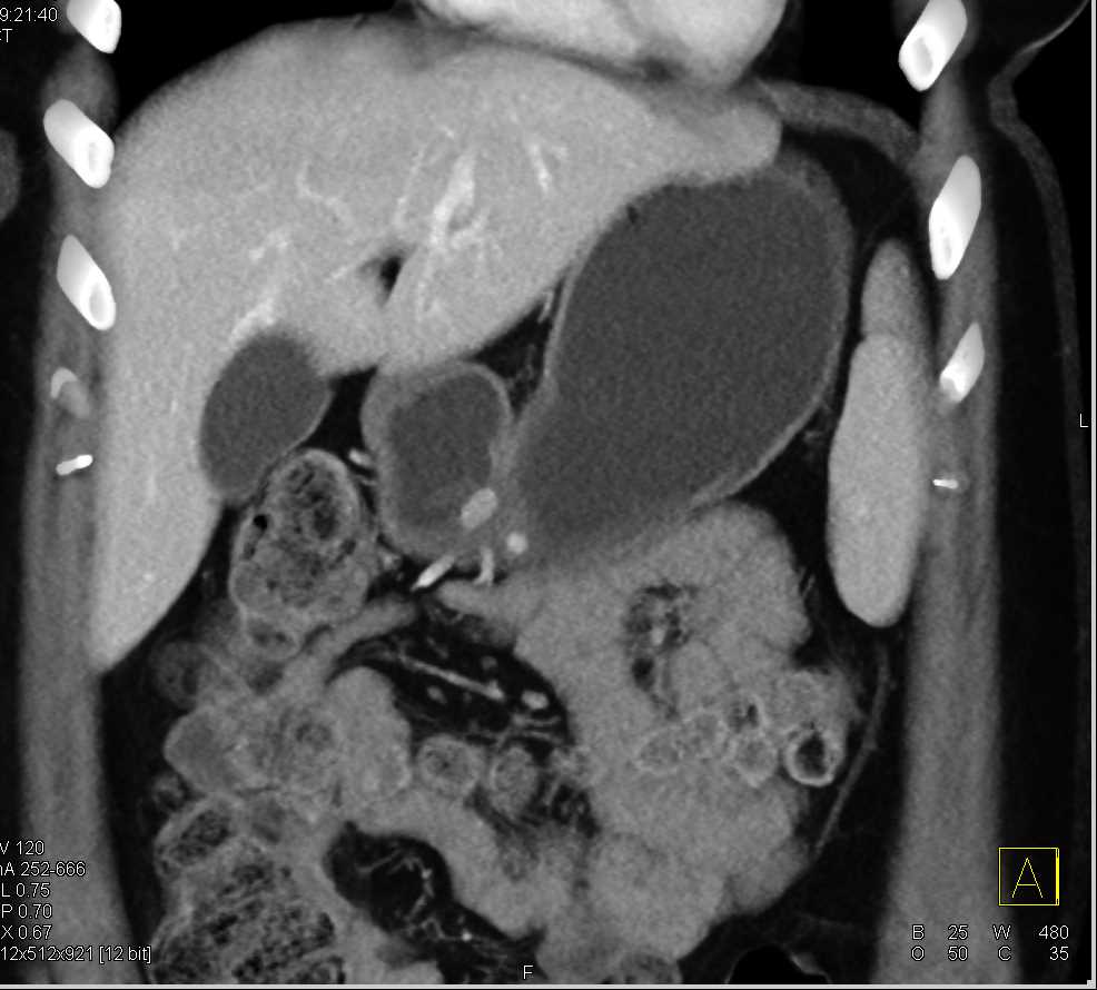 Carcinoid Tumor in the Gastric Antrum - CTisus CT Scan