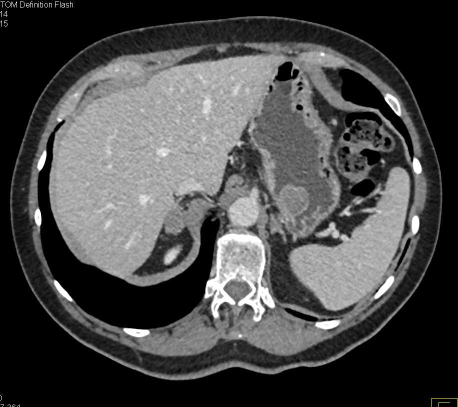 Incidental Gastric GIST Tumor in a Patient with Prostate Cancer - CTisus CT Scan