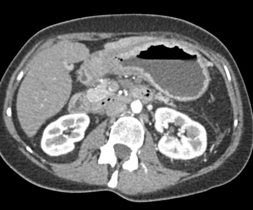 Carcinoma Gastric Antrum with Adenopathy - CTisus CT Scan