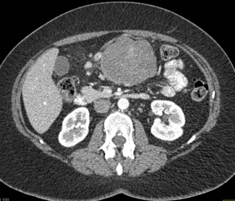 Gastric GIST Tumor - CTisus CT Scan
