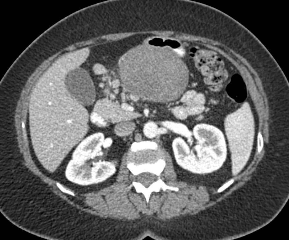 Gastric GIST Tumor - CTisus CT Scan