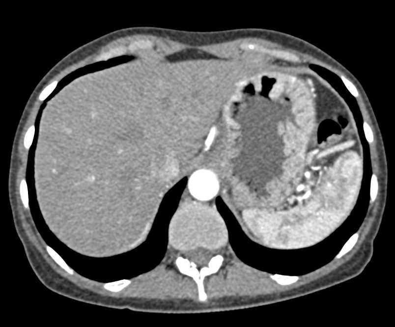 Thickened Gastric Folds due to Lymphoma - CTisus CT Scan