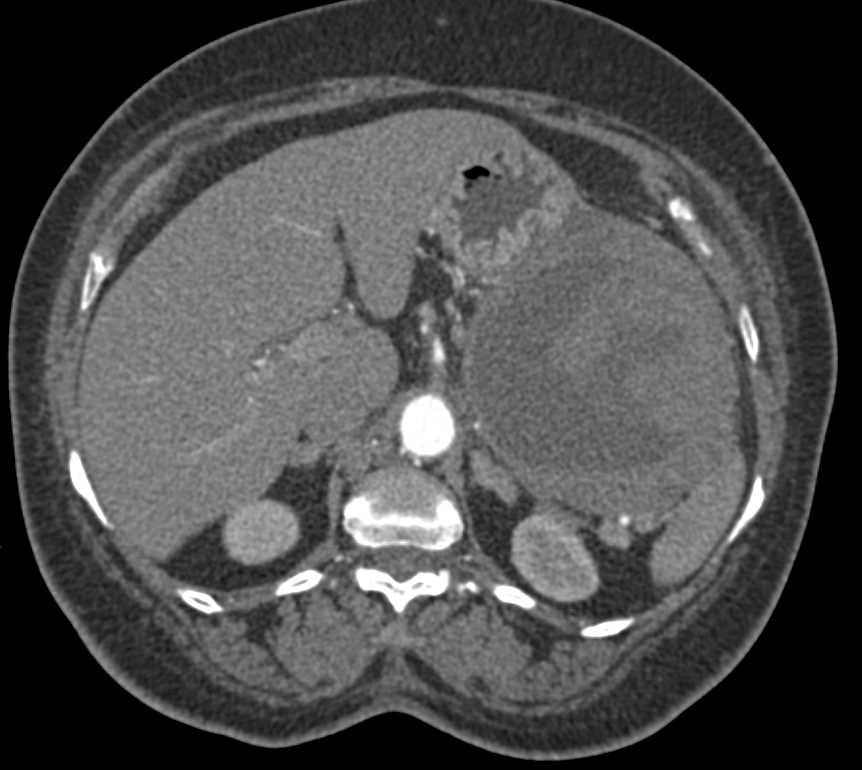 Gastric GIST Tumor - CTisus CT Scan