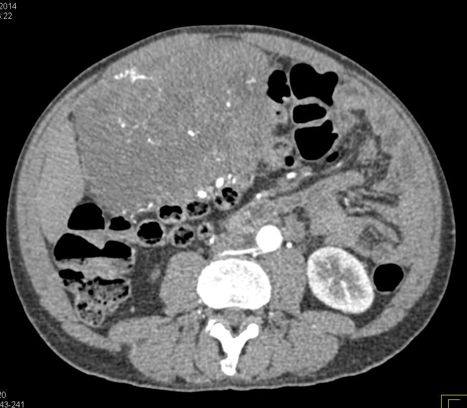 Invasive Gastric GIST Tumor - CTisus CT Scan