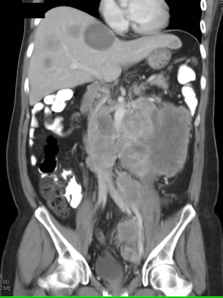 Lymphoma with Bulky Abdominal Nodes - CTisus CT Scan