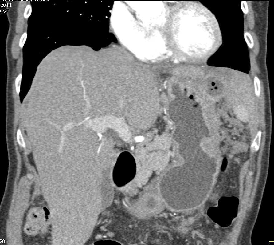 Ulcerating Gastric Adenocarcinoma - CTisus CT Scan