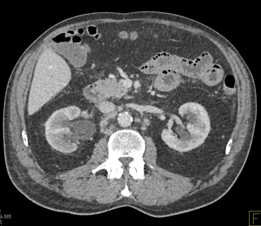 Gastric Adenocarcinoma with Carcinomatosis - CTisus CT Scan