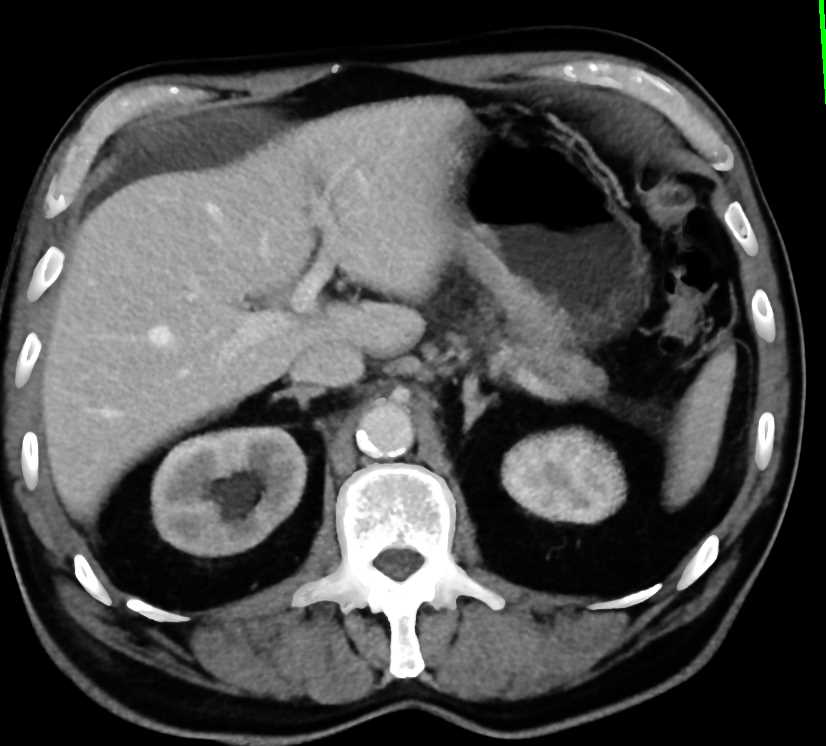 Gastric Adenocarcinoma with Carcinomatosis - CTisus CT Scan