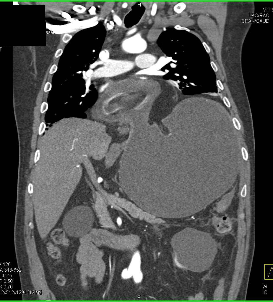 Gastric Volvulus - CTisus CT Scan
