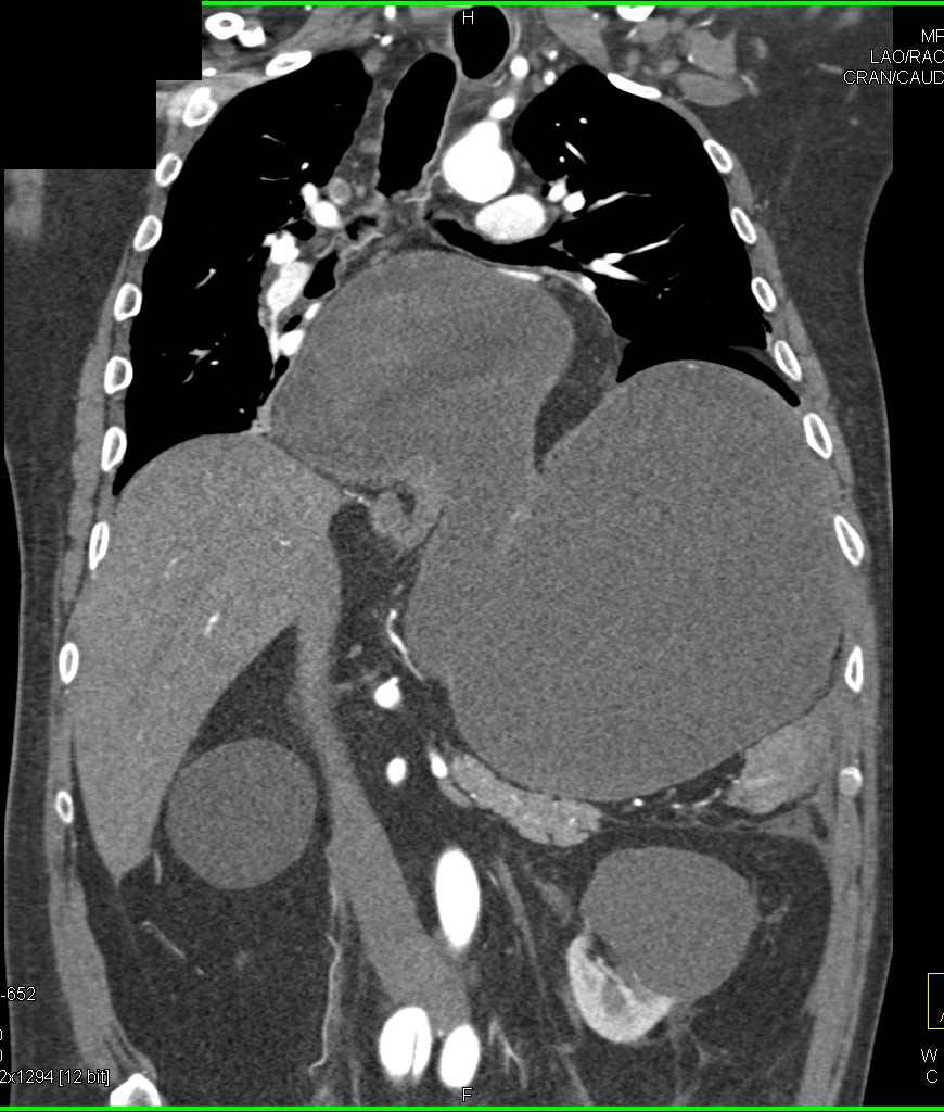 Gastric Volvulus - CTisus CT Scan