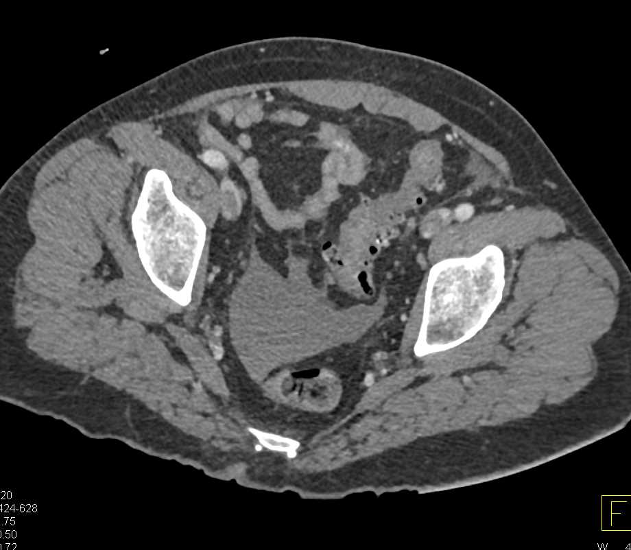 Gastric Volvulus - CTisus CT Scan