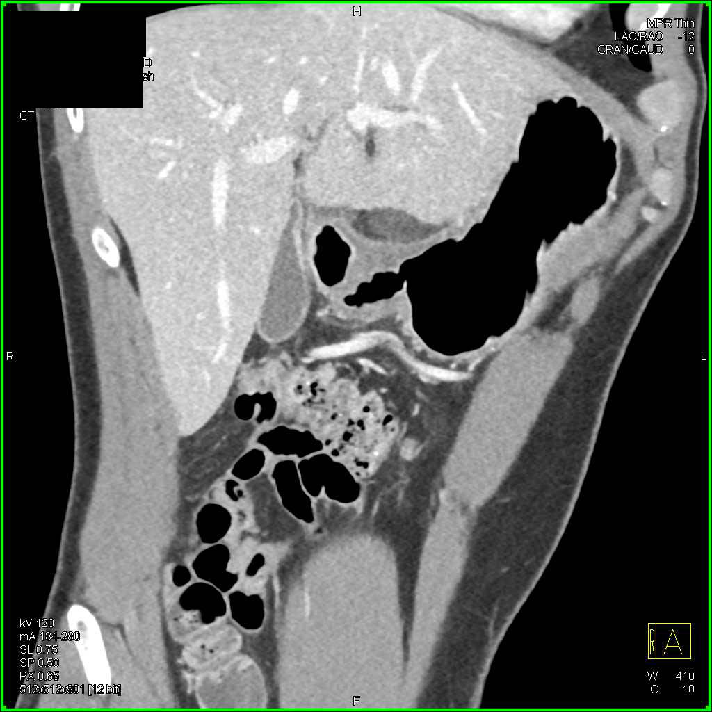Antral Carcinoma - CTisus CT Scan