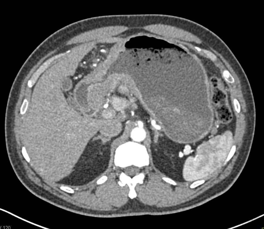 Carcinoma of the Gastric Antrum - CTisus CT Scan
