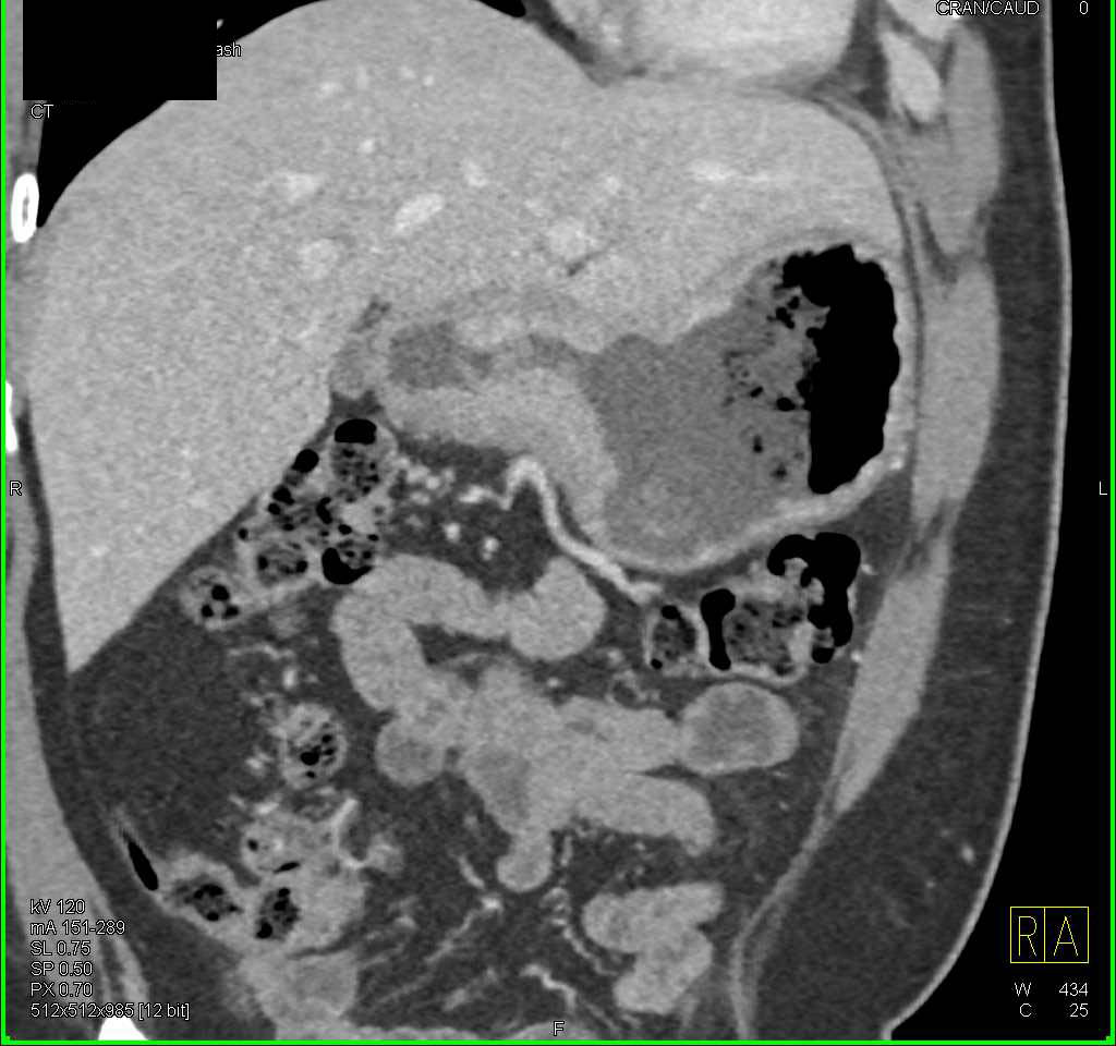 Carcinoma of the Gastric Antrum - CTisus CT Scan