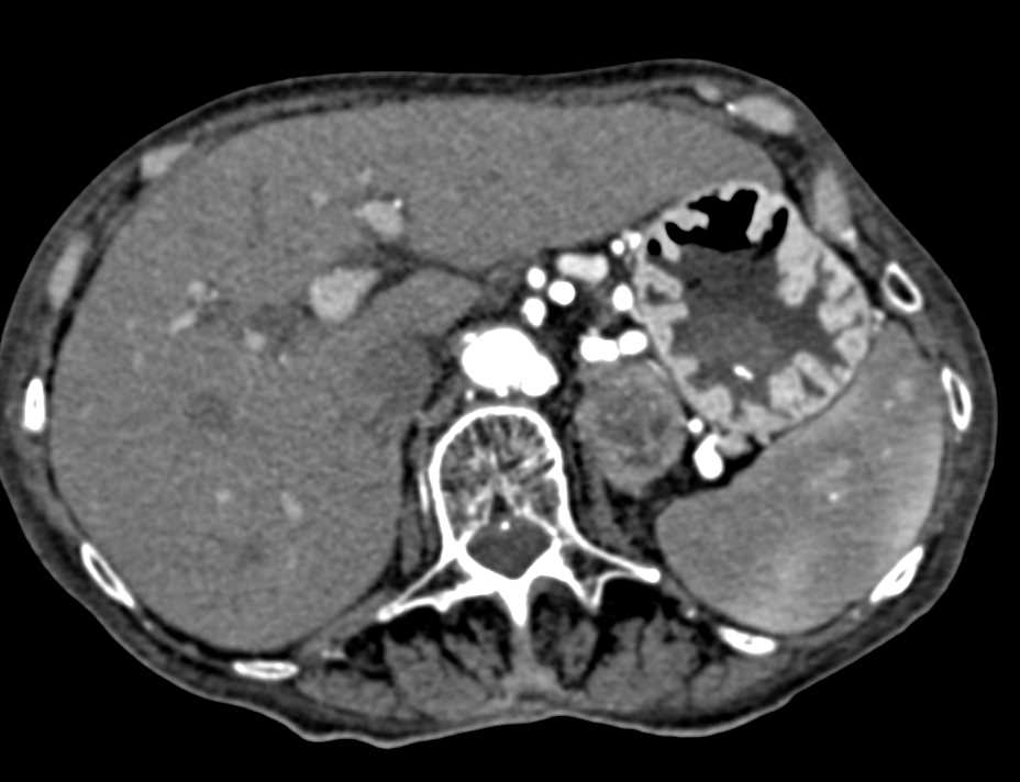 Zollinger-Ellison Syndrome with Thickened Gastric Folds - CTisus CT Scan