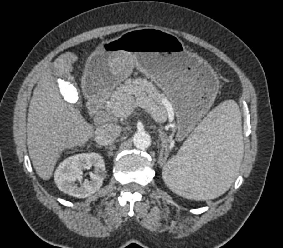 Gastric GIST Tumor - CTisus CT Scan