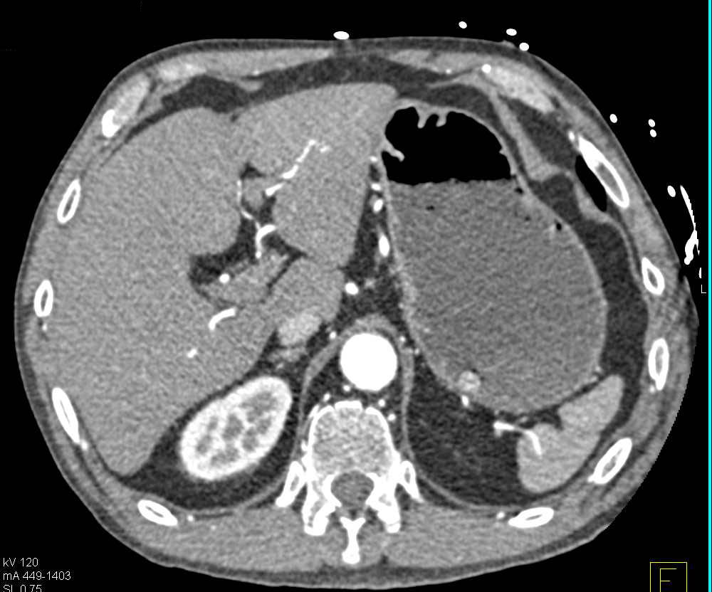 1cm Gastric GIST Tumor in the Fundus - CTisus CT Scan