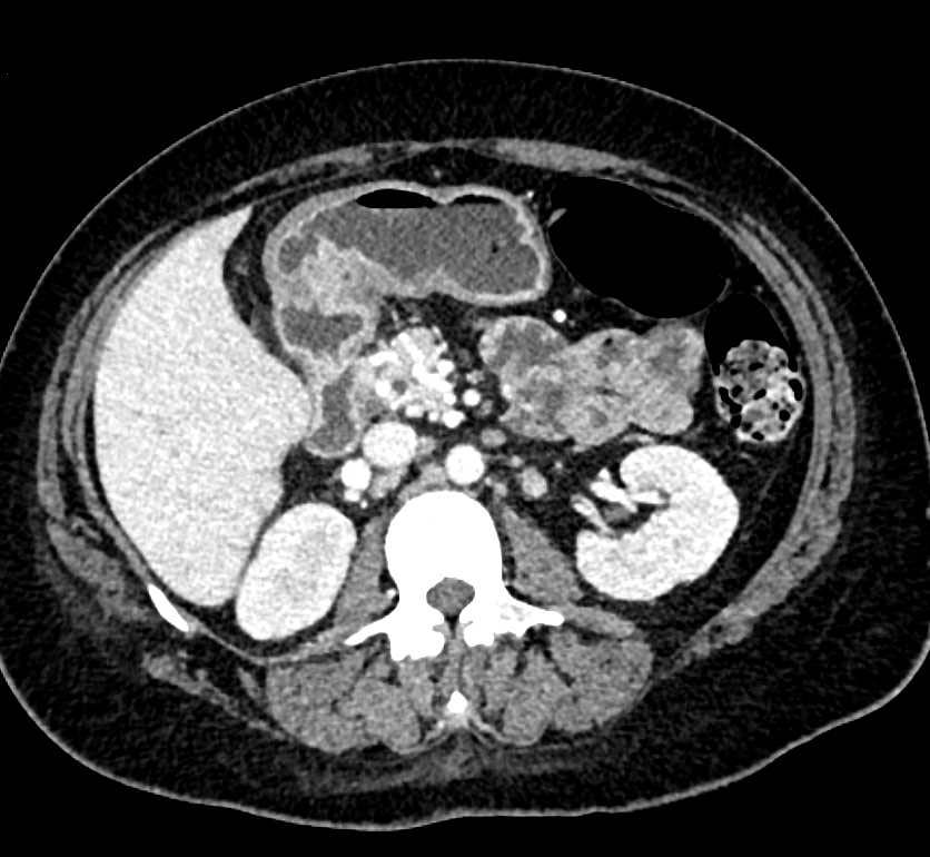Gastric Antral Calcification - CTisus CT Scan