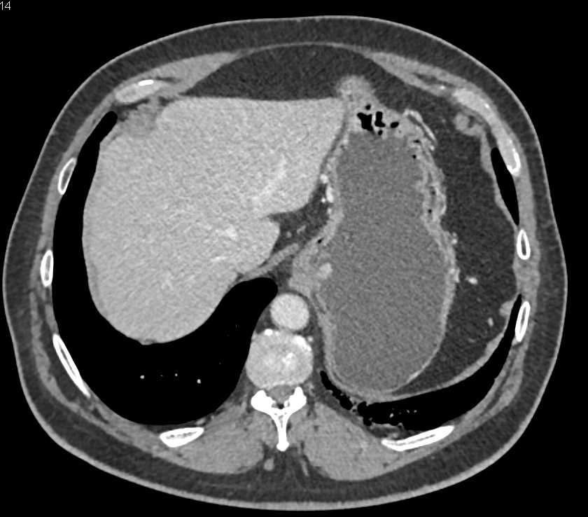 Carcinoma at Gastroesophageal (GE) Junction - CTisus CT Scan