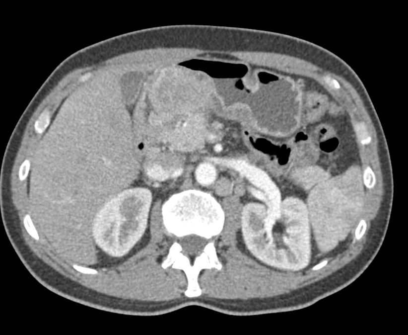 Gastric GIST Tumor Abuts the Pancreas - CTisus CT Scan