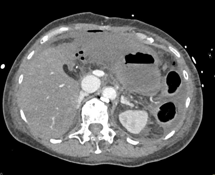 Gastric Perforation and Ischemic Bowel - CTisus CT Scan