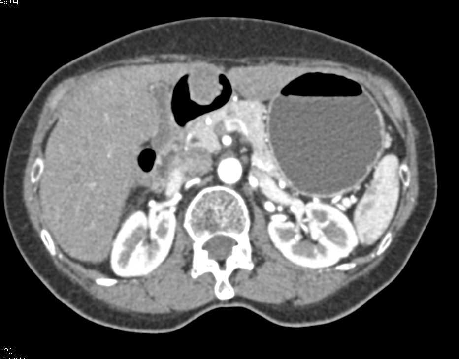 Gastric GIST Tumor - CTisus CT Scan