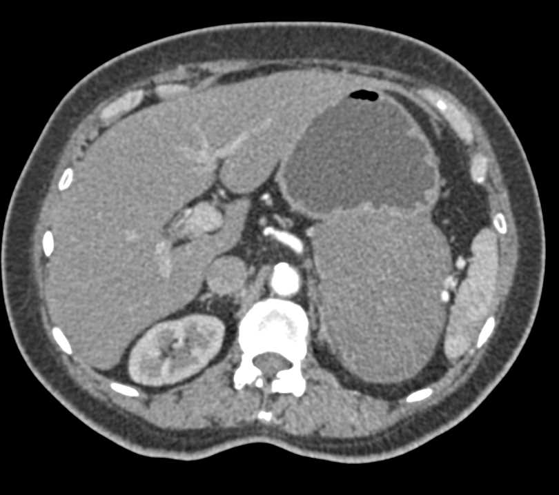 Gastric GIST Tumor - CTisus CT Scan