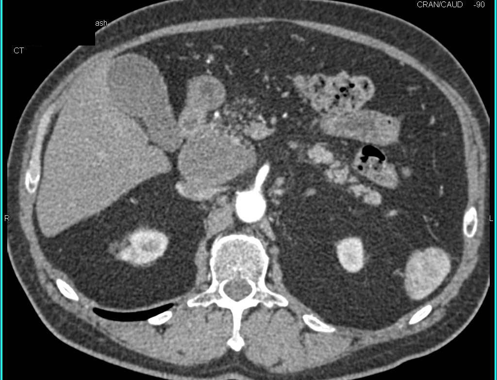 Gastric Carcinoma with Large Portocaval Nodes That Simulate a Pancreatic Mass - CTisus CT Scan