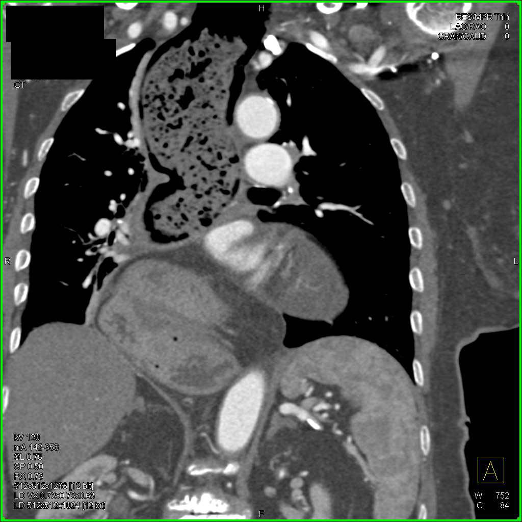 Gastric Pull-up with Thick Folds - CTisus CT Scan