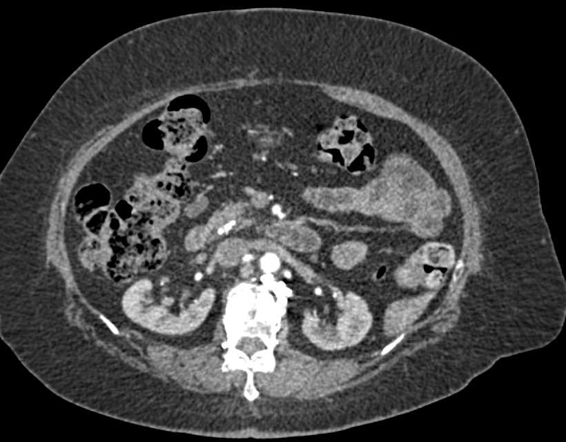 GIST Tumor in Gastric Fundus - CTisus CT Scan