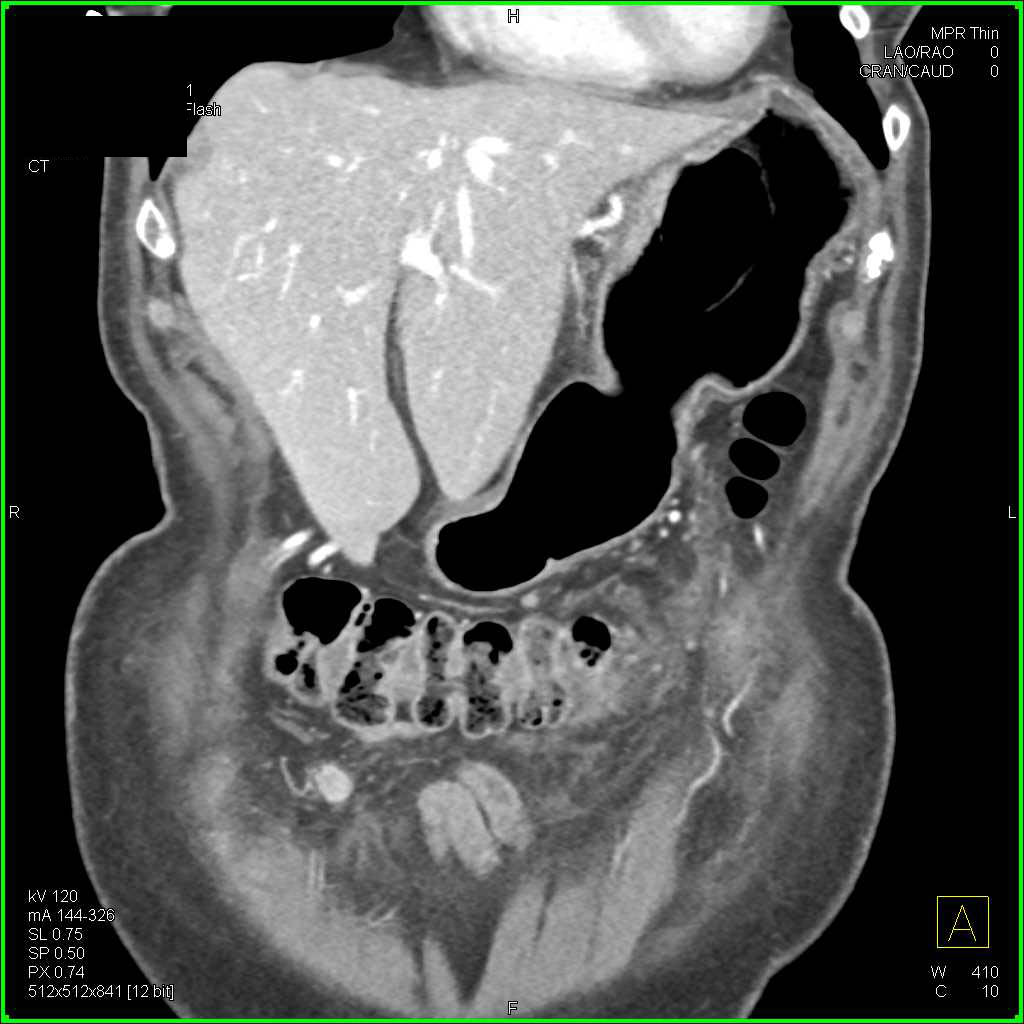 Gastric Adenocarcinoma with Carcinomatosis - CTisus CT Scan