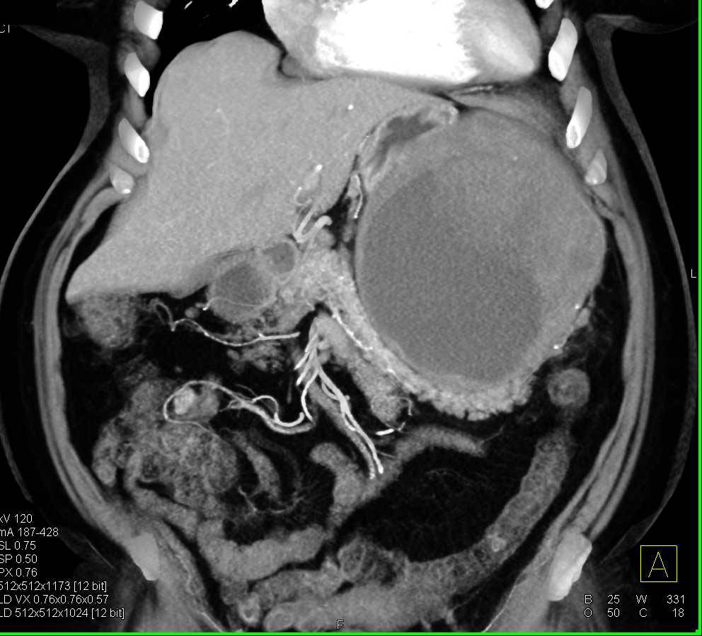 Exophytic Gastric GIST Tumor - CTisus CT Scan