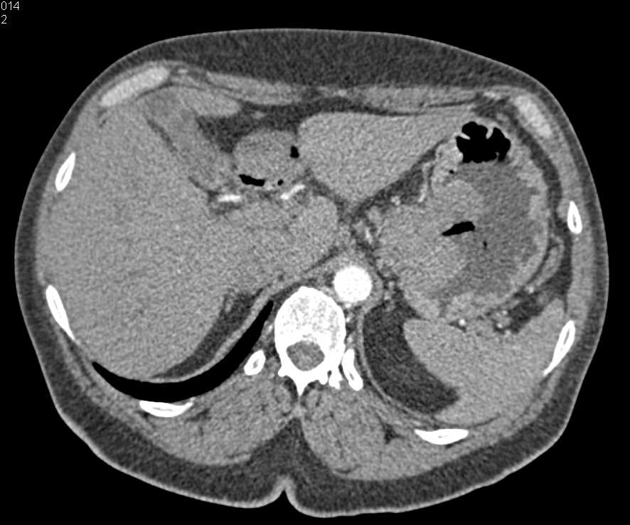 Ulcerating GIST Tumor in the Gastric Fundus - CTisus CT Scan