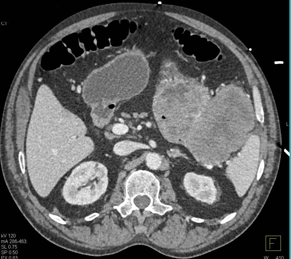 Gastric GIST Tumor - CTisus CT Scan