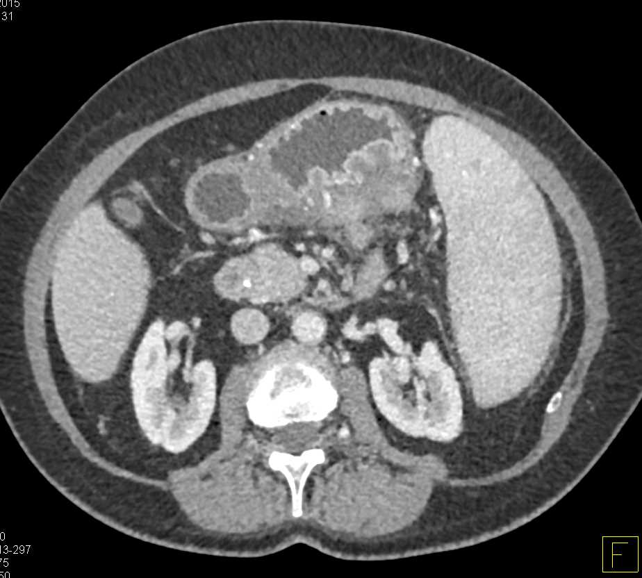 Gastric Lymphoma - CTisus CT Scan