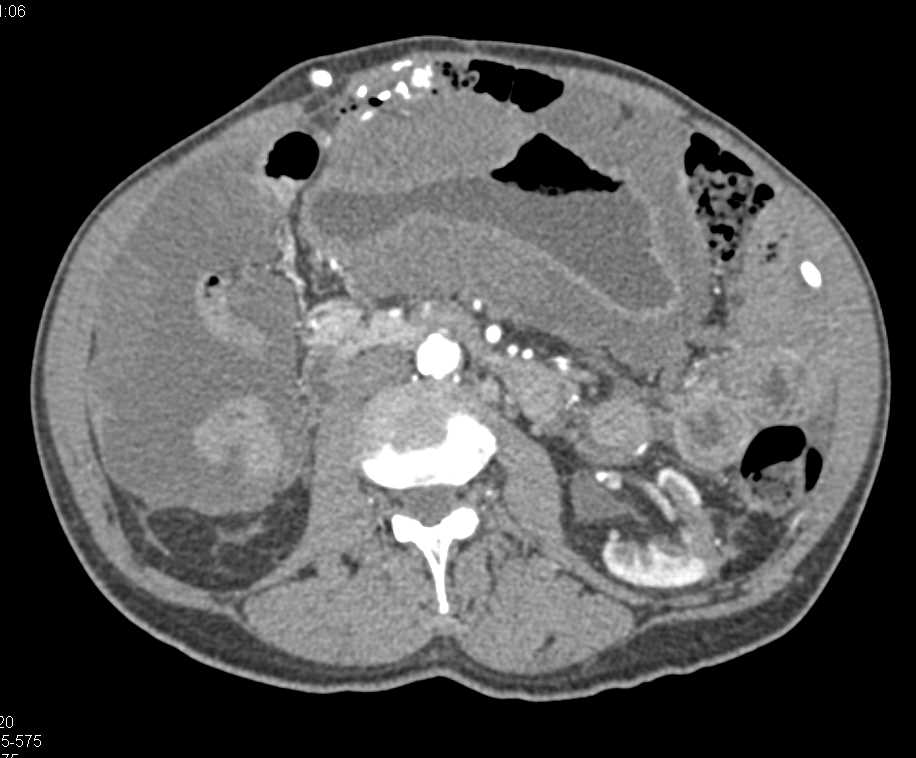Gastric Adenocarcinoma with Pseudomyxoma Peritonei (PMP) - CTisus CT Scan