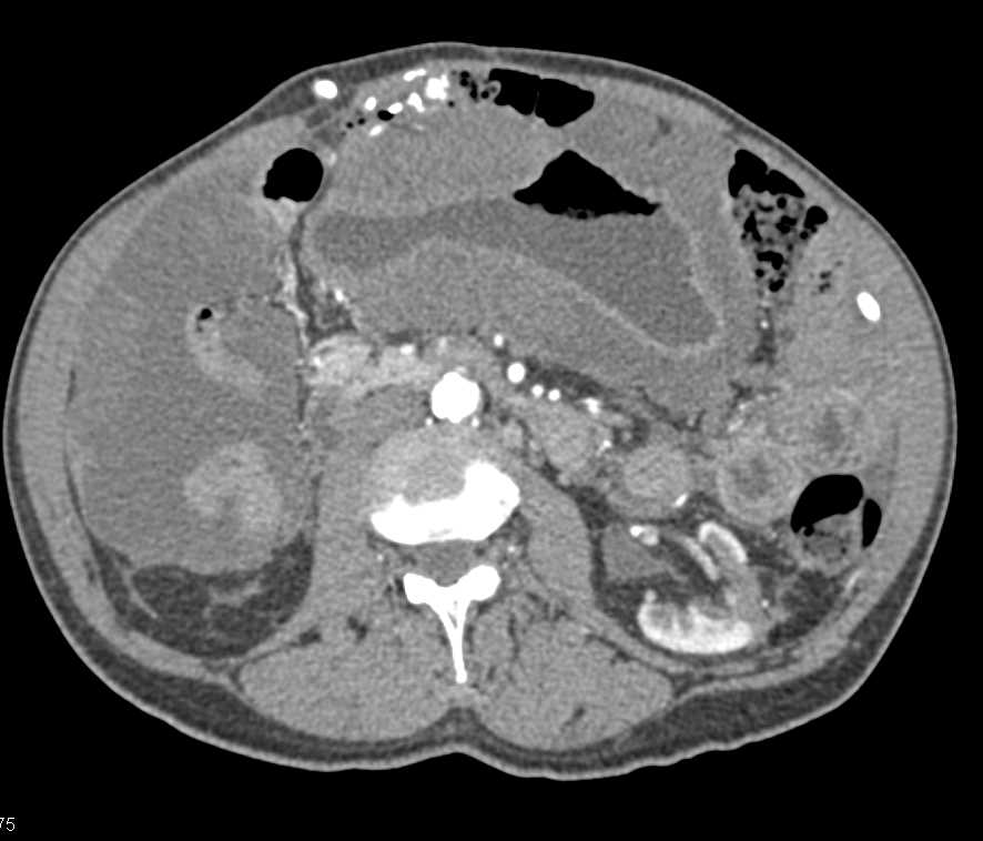 Gastric Adenocarcinoma with Pseudomyxoma Peritonei (PMP) - CTisus CT Scan