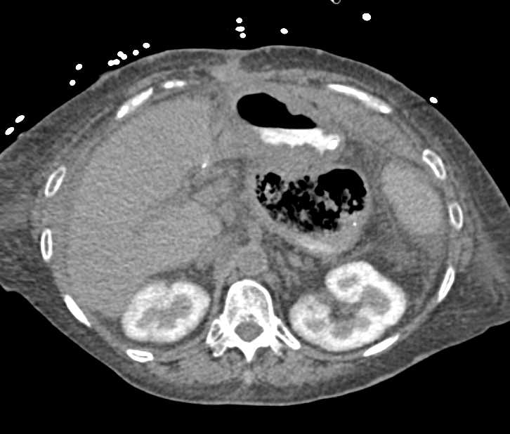Necrotic Gastric Adenocarcinoma - CTisus CT Scan