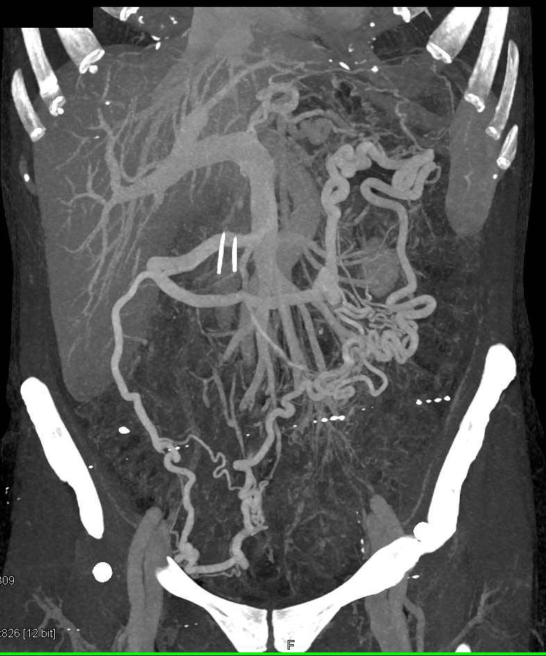 Emphysematous Gastritis with Collateral Vessels - CTisus CT Scan