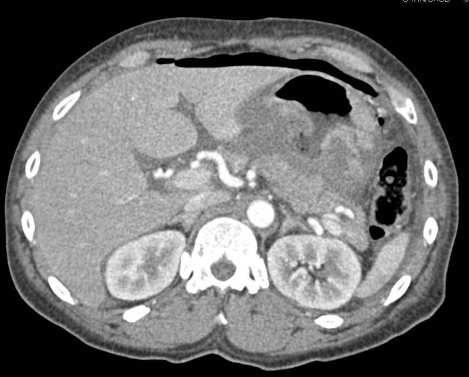 Perforated Gastric Cancer with Bleed and Pneumoperitoneum - CTisus CT Scan