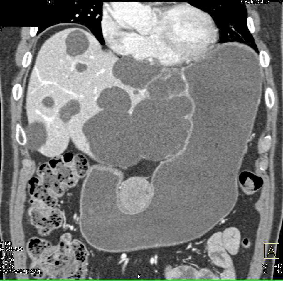 Gastric GIST Tumor and Multiple Liver Cysts - CTisus CT Scan