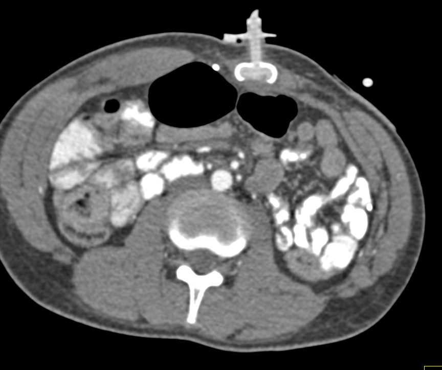 G-Tube is in Abdominal Wall and Not the Stomach - CTisus CT Scan