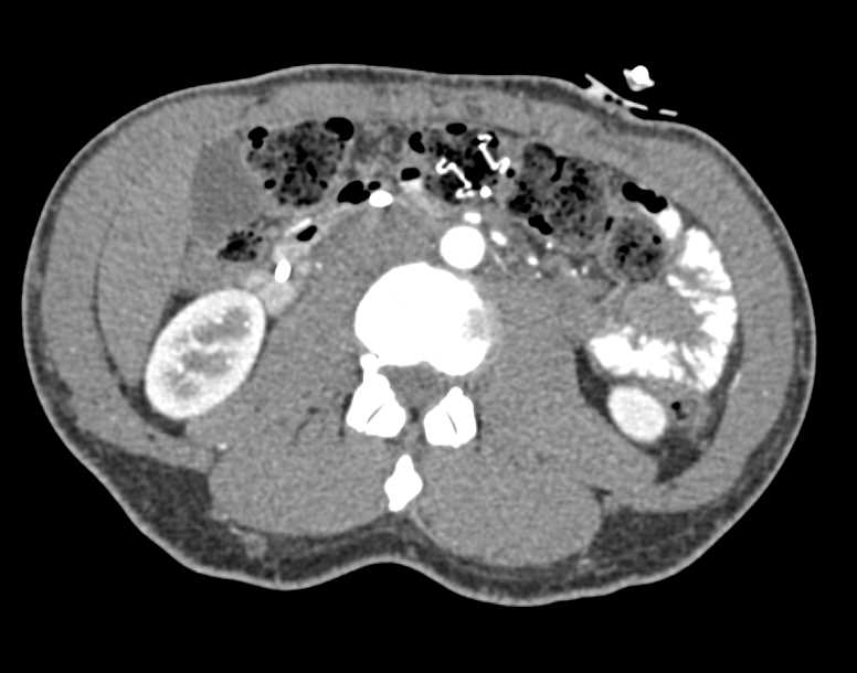 GT Tube is in the Abdominal Wall and About to Fall Out - CTisus CT Scan