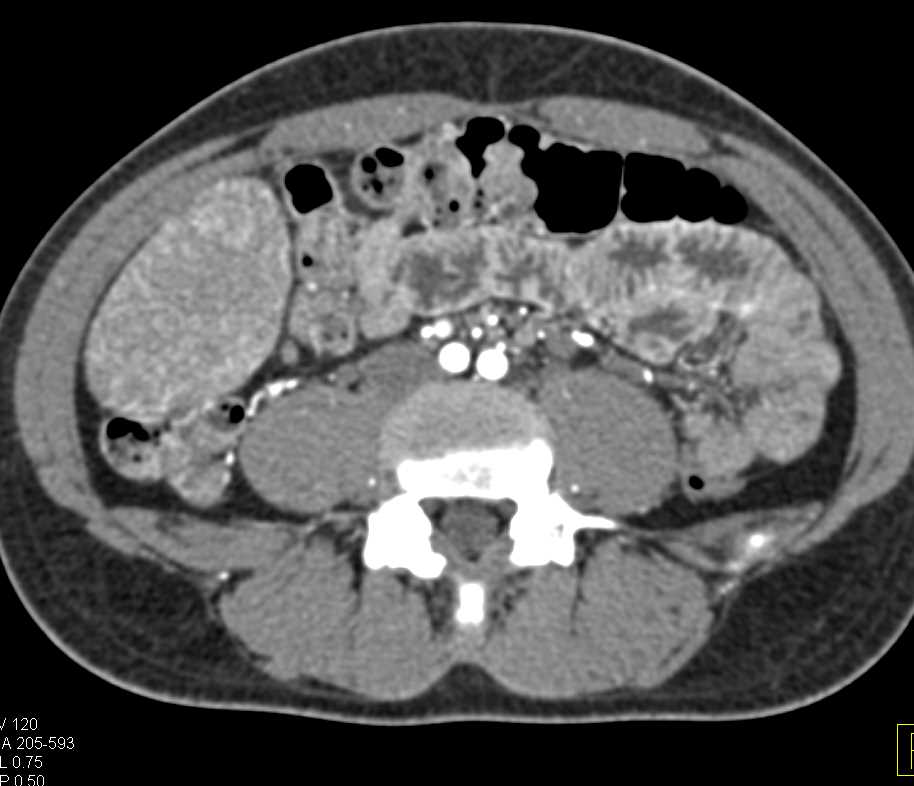 Prominent Gastric Folds - CTisus CT Scan