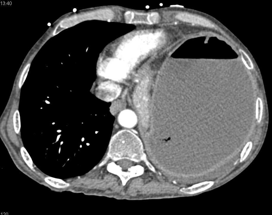 Gastric Outlet Obstruction - CTisus CT Scan